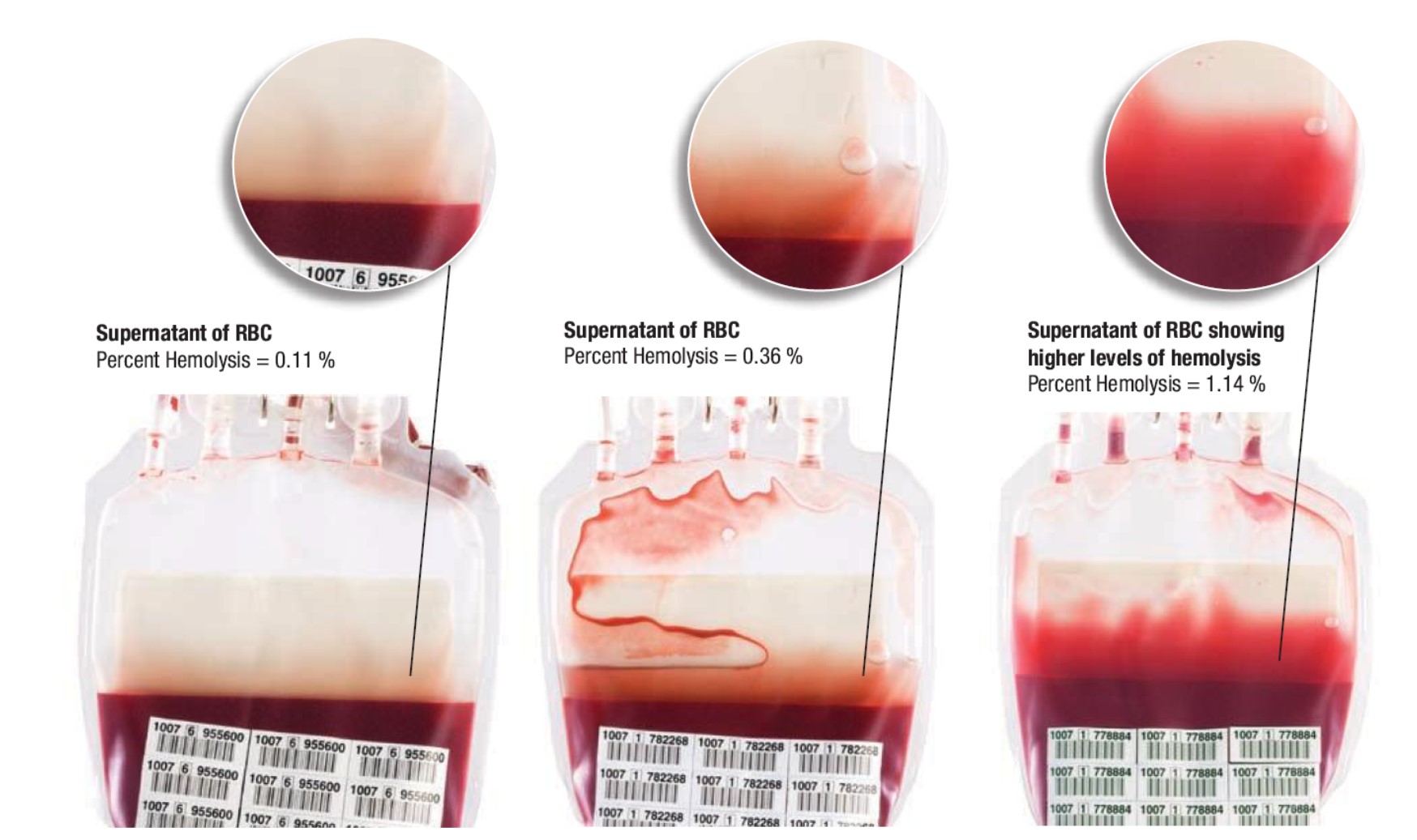 Red blood cells hemolysis professional education